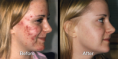 /album/acne-before-and-after/acne-before-after-png/
