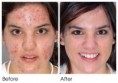 /album/acne-before-and-after/acne-facial-before-after-jpg/