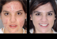 /album/acne-before-and-after/acne-treatment-png/