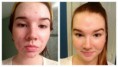 /album/acne-before-and-after/maxresdefault-jpg/