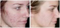 /album/acne-before-and-after/pic-acne-before-after-jpg/